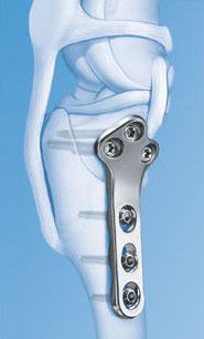 plaque tplo